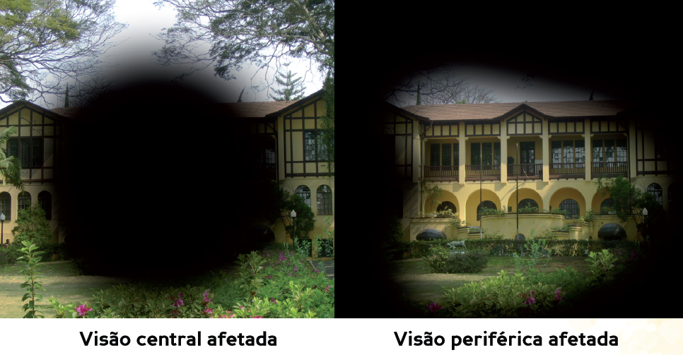 Descrição da imagem: duas fotografias de um casarão amarelo com jardim na frente. Na da esquerda há uma grande mancha preta no centro, representando a visão central afetada. Na da direita há uma mancha preta nas bordas da imagem, representando a visão periférica afetada.